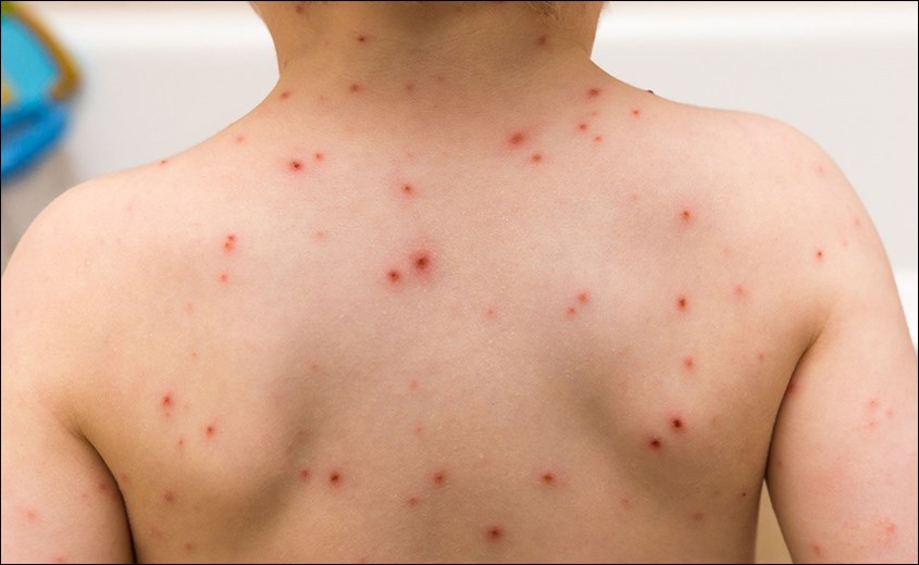 bệnh thường gặp ở trẻ mầm non sẽ có bệnh về da