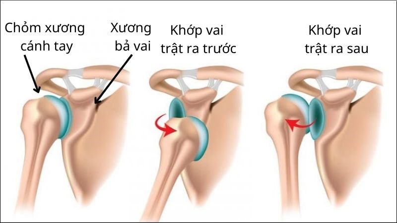 Trật khớp vai là hiện tượng chỏm xương cánh tay sai vị trí so với ổ chảo xương vai Trật khớp vai là hiện tượng chỏm xương cánh tay sai vị trí so với ổ chảo xương vai