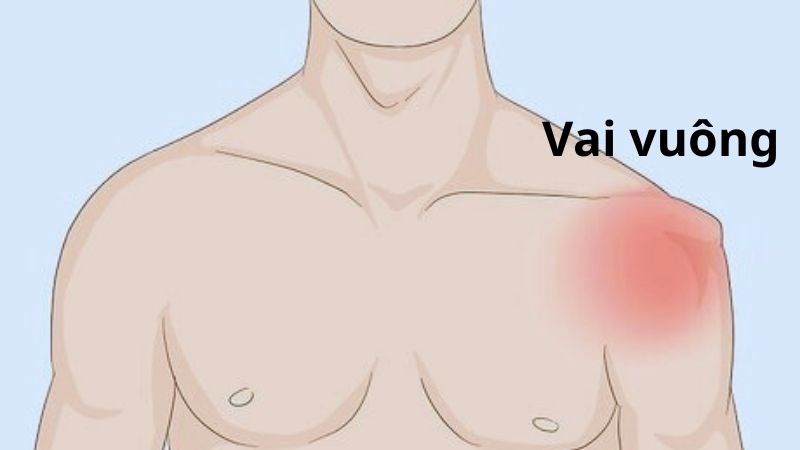 Vai vuông là một trong những dấu hiệu của trật khớp vai Vai vuông là một trong những dấu hiệu của trật khớp vai