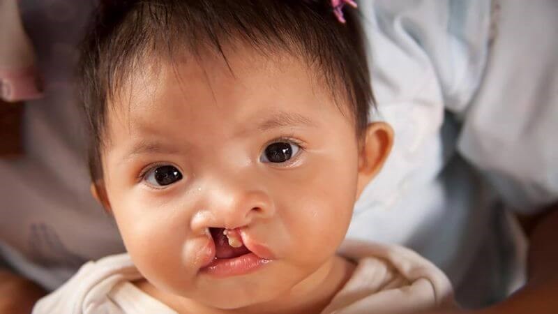 Trẻ mắc u nguyên bào thần kinh thường kèm theo các dị tật bẩm sinh khác Trẻ mắc u nguyên bào thần kinh thường kèm theo các dị tật bẩm sinh khác