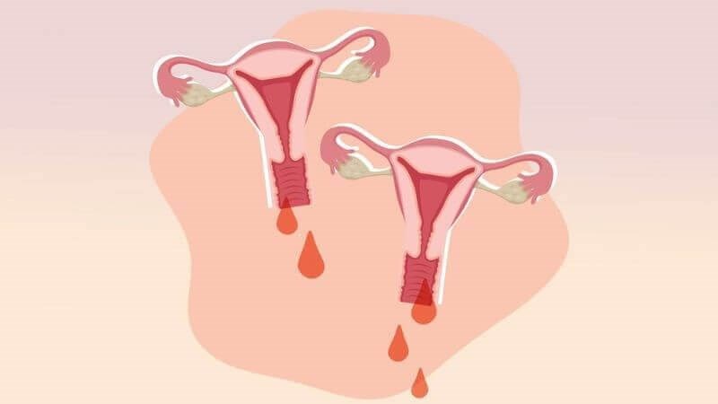 Chảy máu âm đạo bất thường có thể là triệu chứng của bệnh
