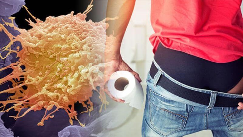 Ung thư hậu môn là tình trạng các tế bào hậu môn tăng sinh không kiểm soát của cơ thể Ung thư hậu môn là tình trạng các tế bào hậu môn tăng sinh không kiểm soát