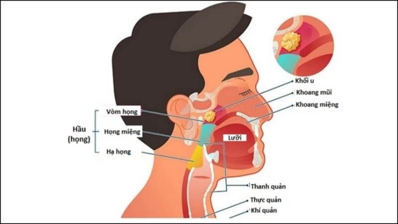 Ung thư vòm họng là ung thư vùng đầu mặt cổ phổ biến