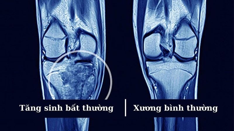Sự tăng sinh bất thường là nguyên nhân phổ biến gây ra ung thư xương