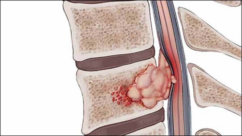Ghép tủy có thể tăng nguy cơ mắc ung thư xương