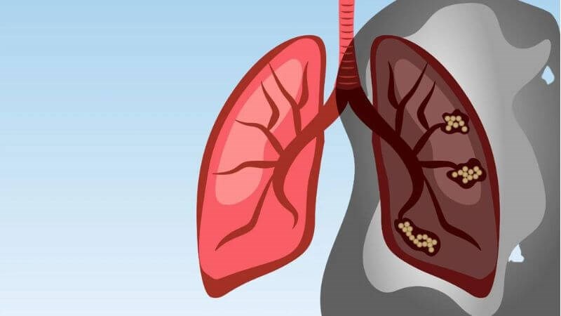 Ung thư phổi là một trong những loại ung thư phổ biến nhất ở cả 2 giới