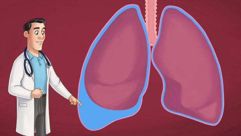 Bệnh ung thư ở giai đoạn cuối có thể gây ra tràn dịch màng phổi