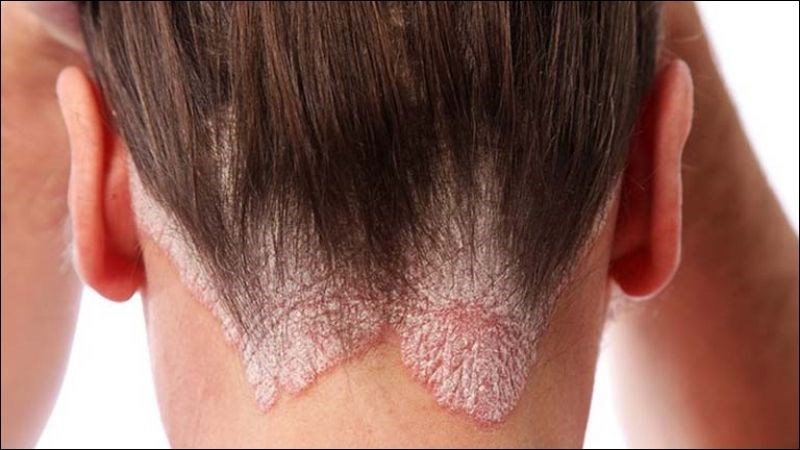 Bệnh vảy nến gây ra tình trạng viêm và bong tróc da