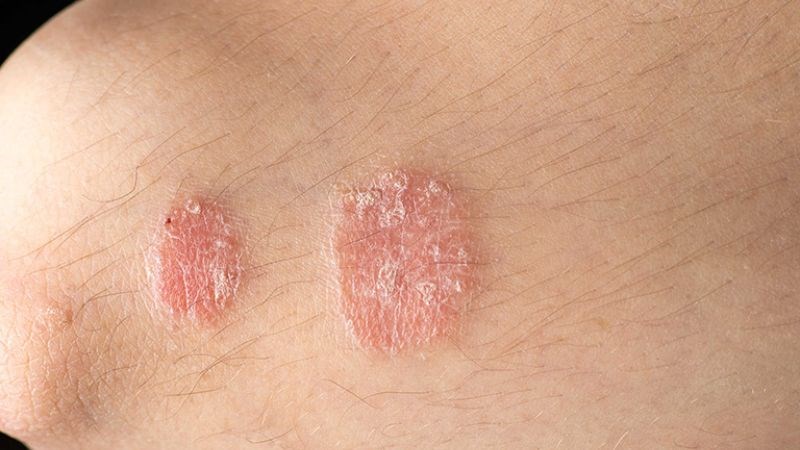 Da đỏ, dày, có vảy là một trong dấu hiệu của bệnh vảy nến