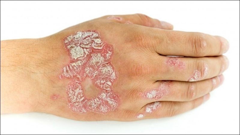 Bệnh vảy nến không lây truyền qua tiếp xúc từ người này sang người khác