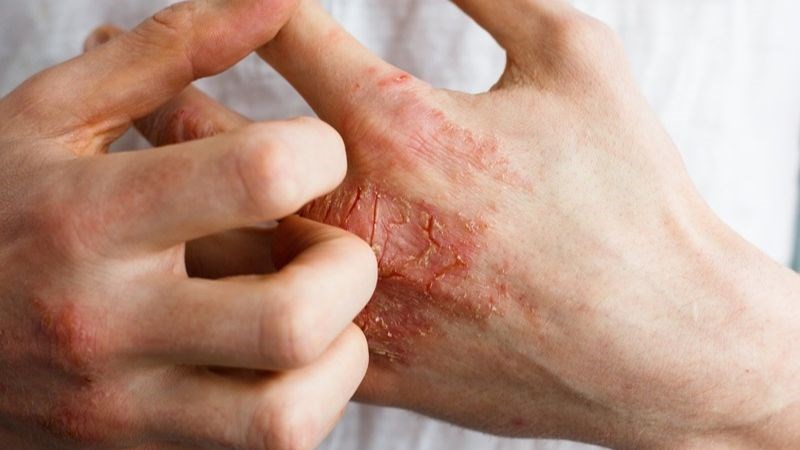 Bệnh vảy nến có thể gây ra biến chứng nhiễm trùng