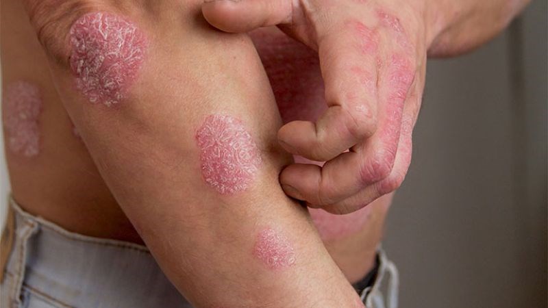 Cần gặp bác sĩ nếu có một trong số các dấu hiệu và triệu chứng của bệnh vảy nến