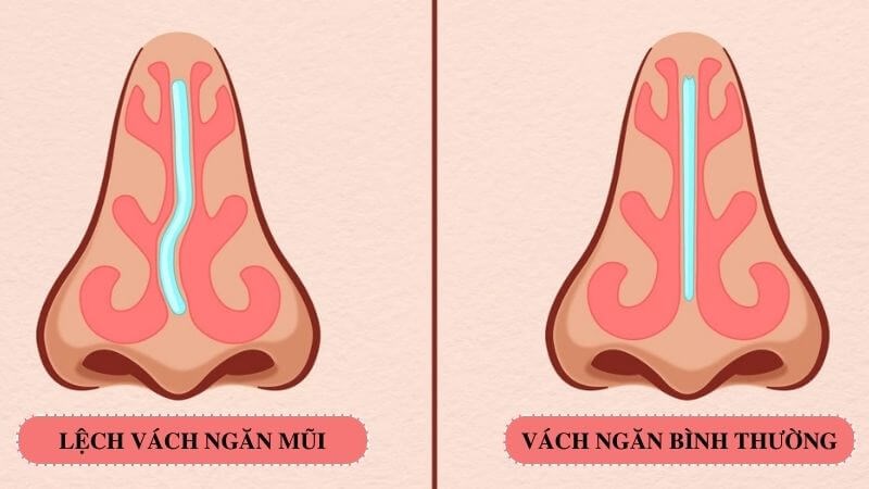 7. Phòng ngừa và chế độ sinh hoạt khi bị lệch vách ngăn mũi