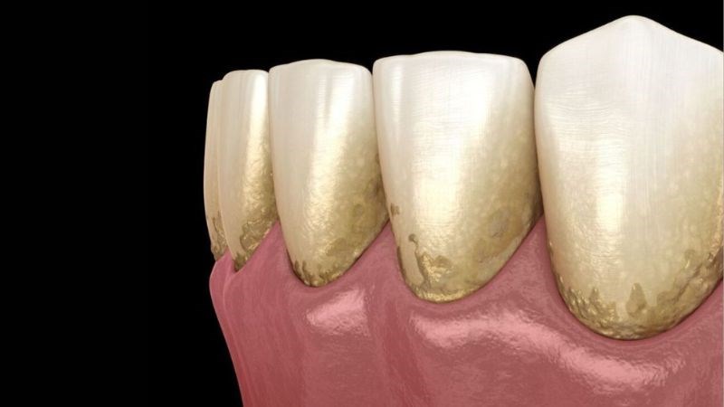 Mảng bám hình thành trên răng có thể gây viêm lợi Mảng bám hình thành trên răng có thể gây viêm lợi