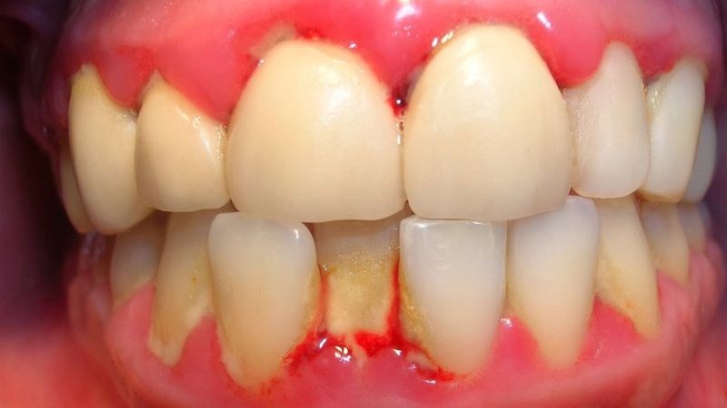 Cao răng gây viêm nhiễm niêm mạc lợi, sưng nề và chảy máu Cao răng gây viêm nhiễm niêm mạc lợi, sưng nề và chảy máu