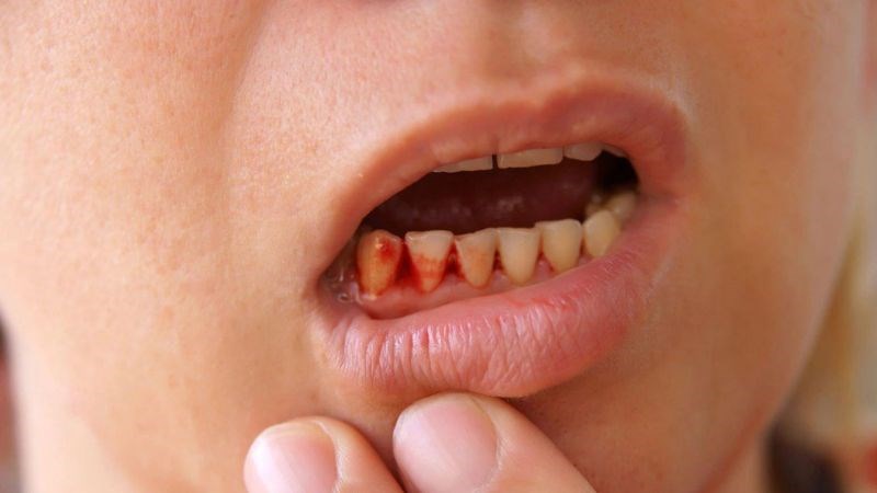 Lợi bị tổn thương có thể gây chảy máu, viêm nhiễm Lợi bị tổn thương có thể gây chảy máu, viêm nhiễm