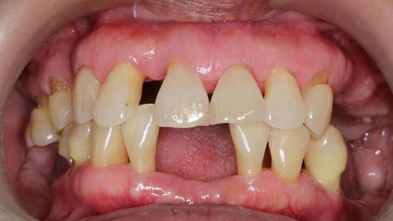 Viêm lợi mức độ nặng có thể dẫn đến mất răng Viêm lợi mức độ nặng có thể dẫn đến mất răng