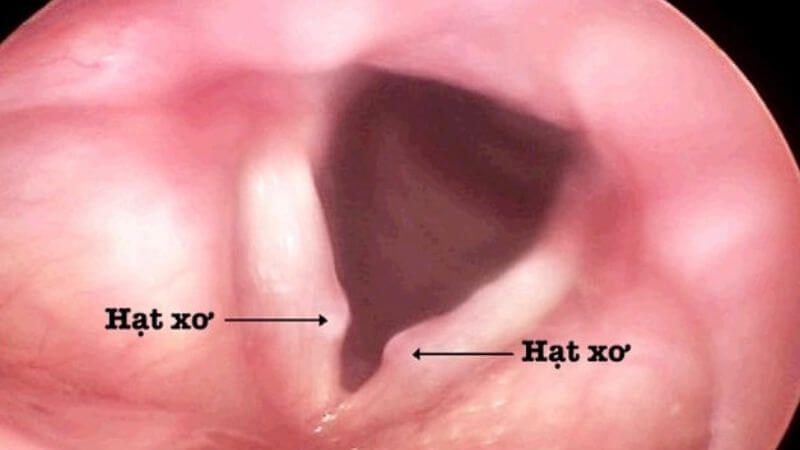 Viêm thanh quản mạn tính có thể dẫn đến hình thành hạt xơ dây thanh