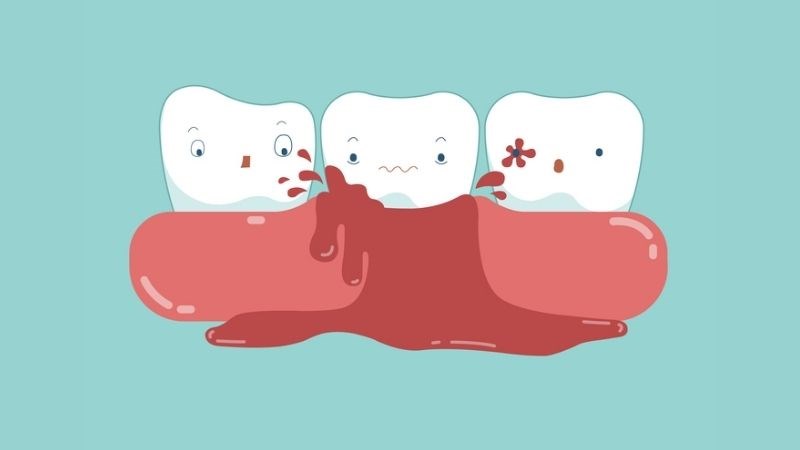 Người bệnh von Willebrand khi làm răng máu sẽ chảy nặng hơn