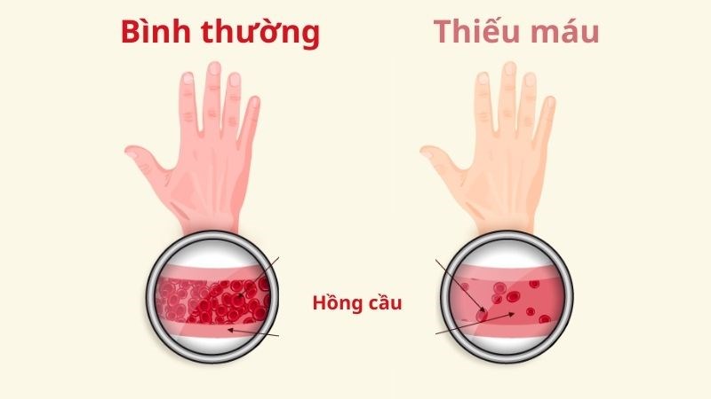 Thiếu máu trong bệnh von Willebrand là do mất sắt khi xuất huyết nhiều