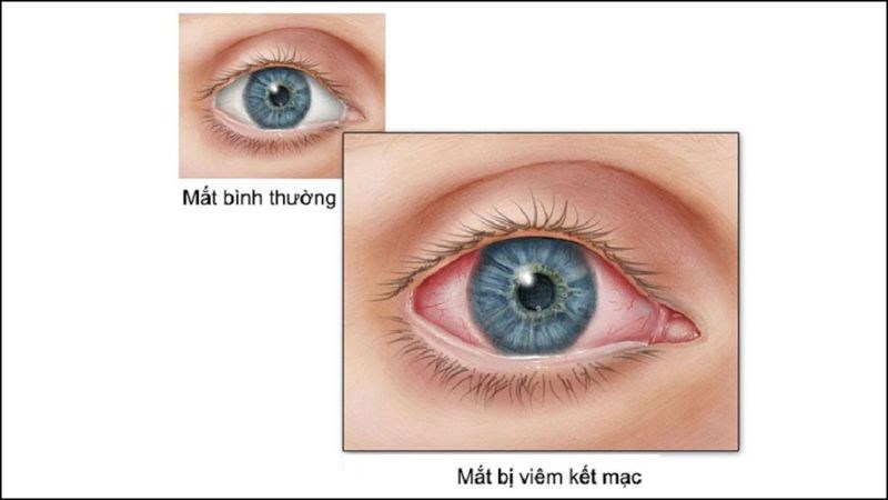 Tùy vào loại đau mắt đỏ và phương pháp điều trị mà thời gian khỏi bệnh sẽ khác nhau