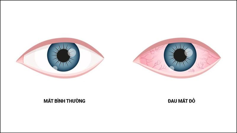 Đỏ mắt là triệu chứng điển hình của bệnh đau mắt đỏ