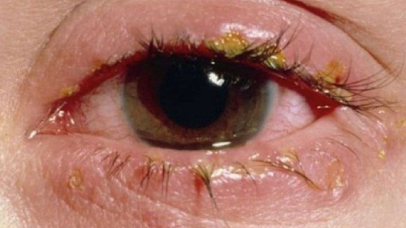 Vi khuẩn cũng là một tác nhân gây ra bệnh đau mắt đỏ