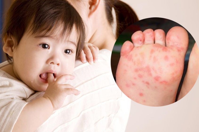 Biến chứng bệnh tay chân miệng