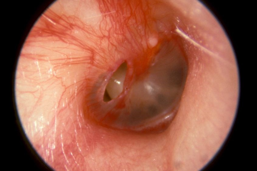 Biến chứng viêm tai giữa ở trẻ