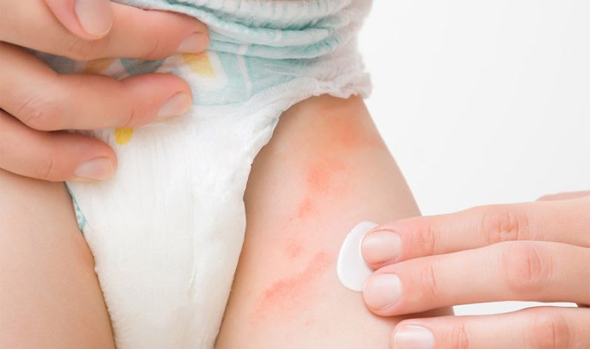 Mùa hè nên đóng bỉm cho bé đúng cách