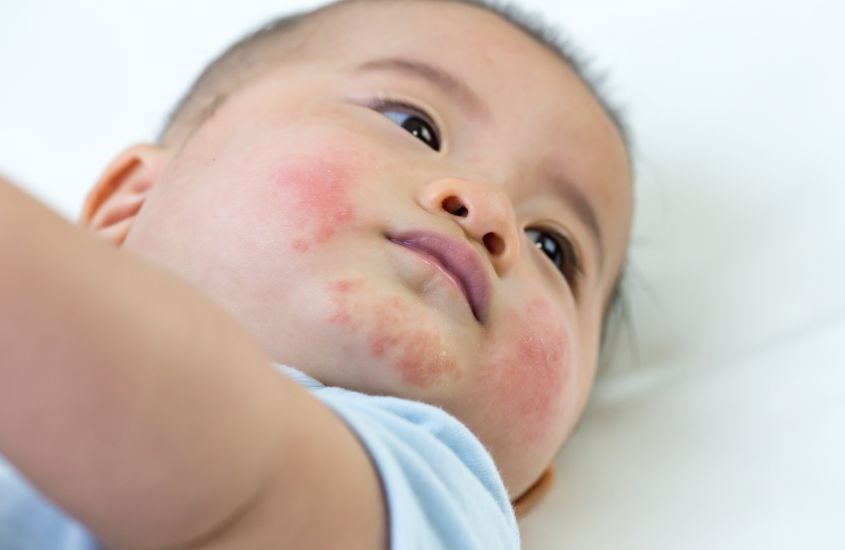 Lợi khuẩn giúp làm giảm các nguy cơ mắc bệnh về da