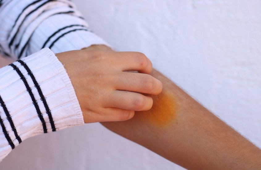 Bổ sung lợi khuẩn bifidobacterium và lactobacillus giúp giảm nguy cơ dị ứng và viêm da cơ địa