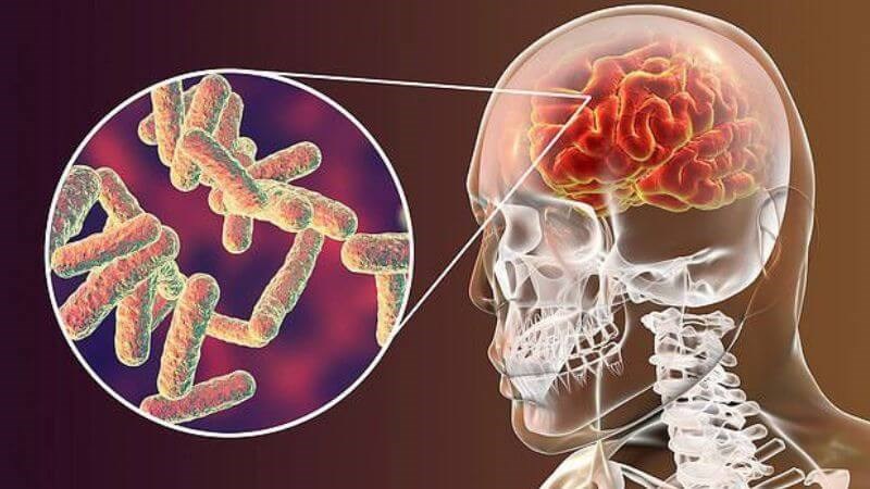 Nhiễm virus Nipah có thể dẫn đến viêm màng não gây tổn thương thần kinh