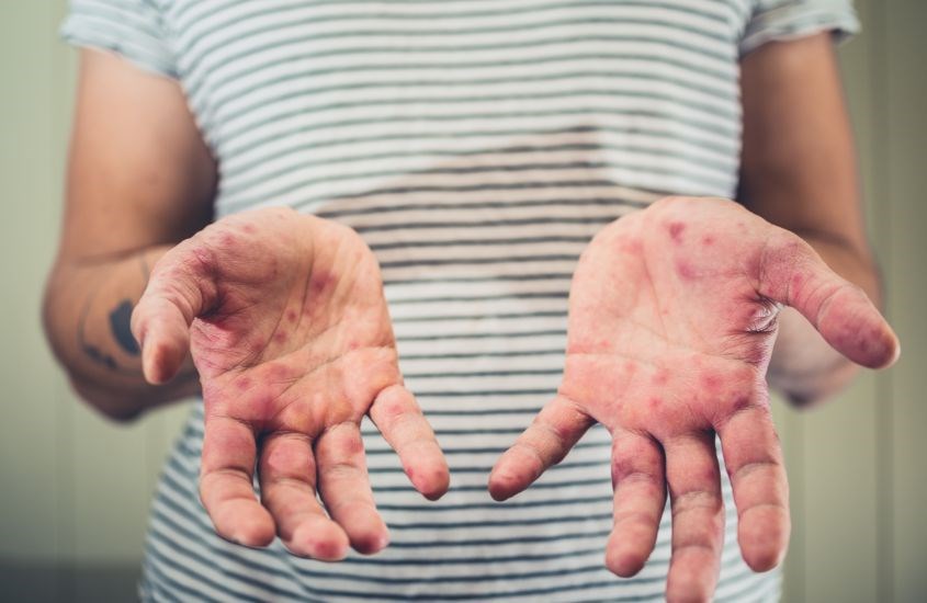 Bệnh tay chân miệng thường gặp ở trẻ em dưới 5 tuổi và dưới 10 tuổi