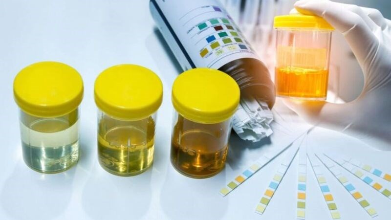 Xét nghiệm nước tiểu đưa ra 11 chỉ số đánh giá cơ bản