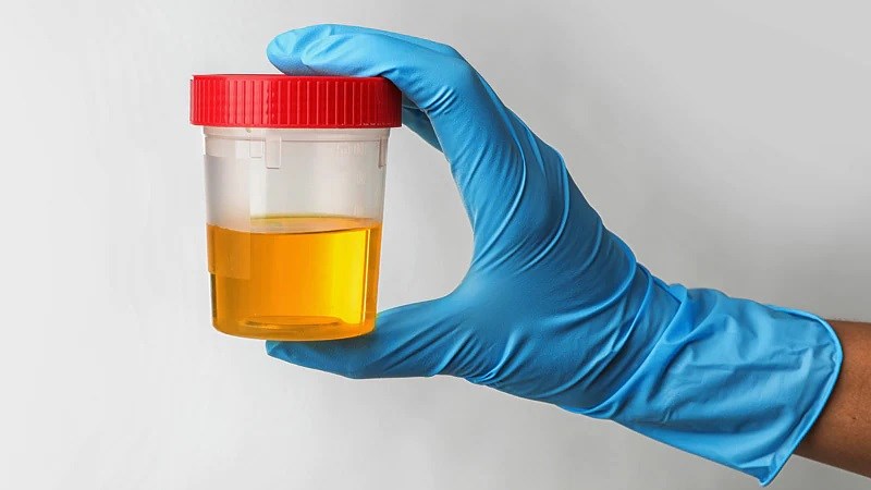 Nồng độ GLU cao hơn bình thường có thể nguyên nhân do đái tháo đường không kiểm soát