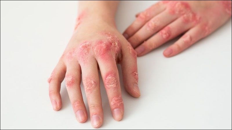 Nổi săng trên da và bộ phận sinh dục là dấu hiệu của giang mai giai đoạn đầu 