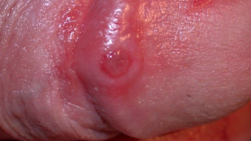 Nổi sẩn ướt trên niêm mạc là dấu hiệu của giang mai giai đoạn 2
