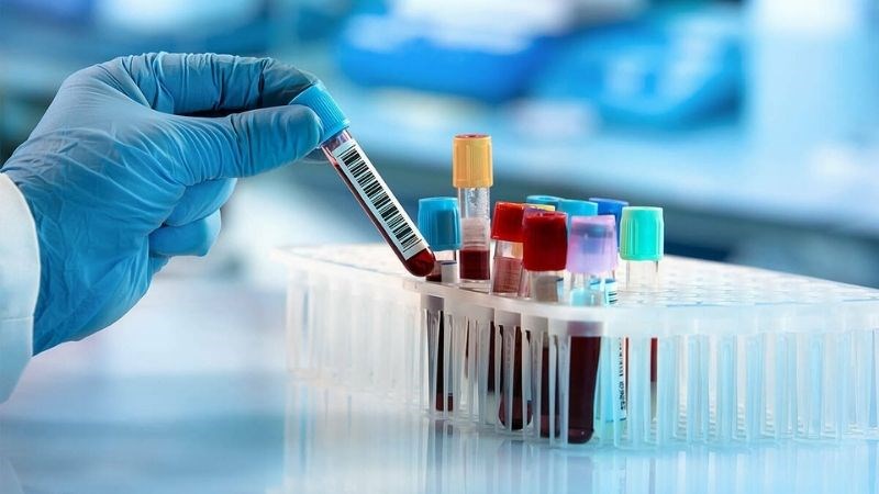 Xét nghiệm máu có thể giúp chẩn đoán bệnh giang mai