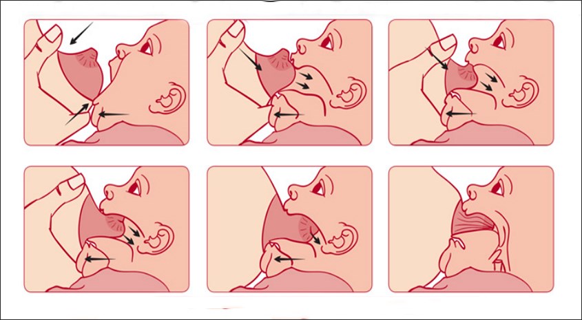 hướng dẫn điều chỉnh khớp ngậm cho bé