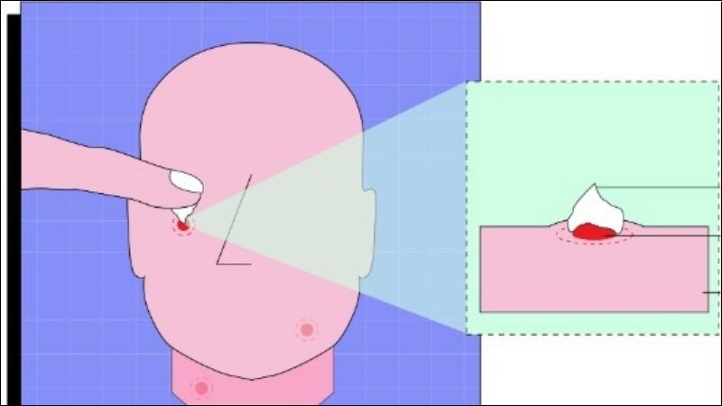 Bạn có thể dùng ngón tay hoặc dụng cụ chấm nhẹ kem trị mụn lên vùng da bị ảnh hưởng