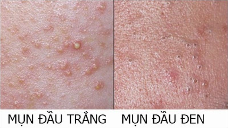 Mụn có thể nặn là những loại mụn không viêm gồm mụn đầu đen và mụn đầu trắng