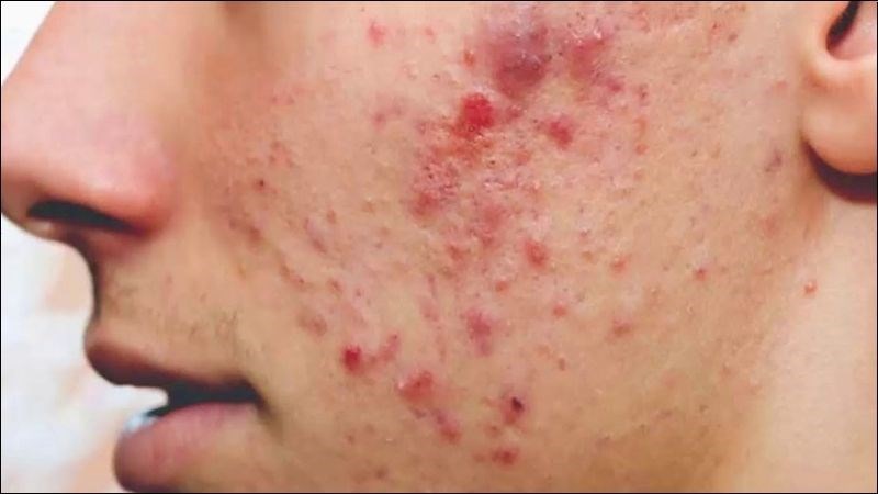 Mụn đỏ, mụn bọc, mụn nang là những loại mụn không thể nặn