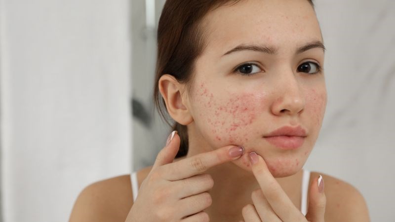 Việc tự nặn mụn tại nhà thường không được khuyến khích