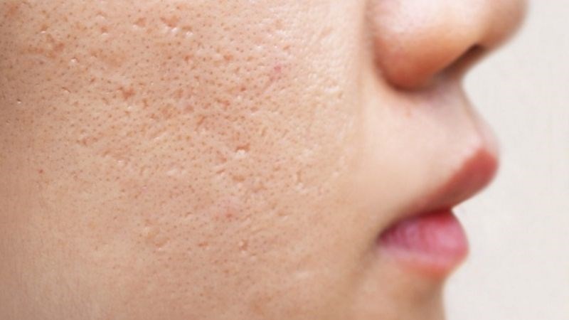 Cố gắng tự nặn mụn có thể dẫn đến sẹo mụn