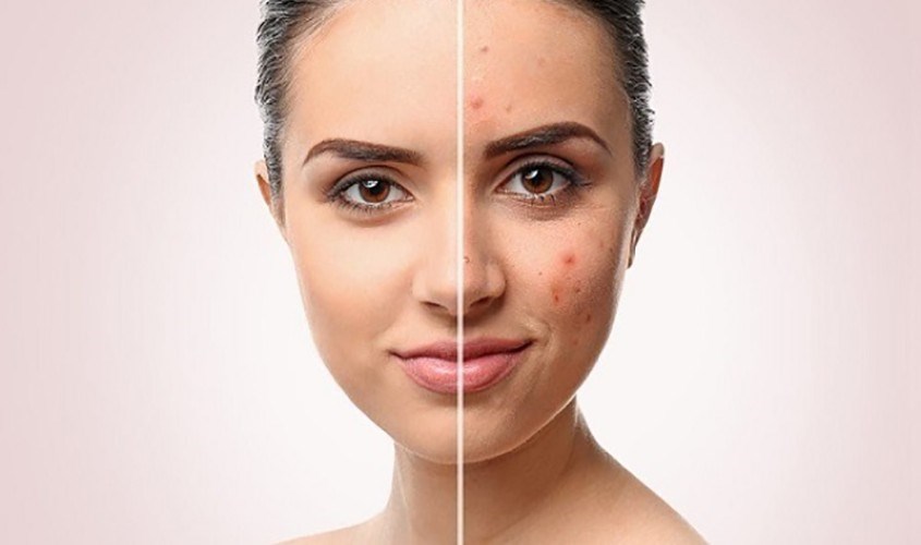 Dầu mù u giảm mụn, mờ thâm, cải thiện tàn nhang