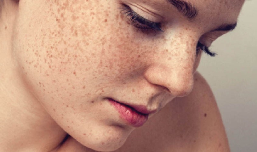 Dầu mù u không thể điều trị tình trạng nám nặng, lâu năm.