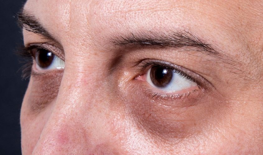 Quầng thâm mắt còn là dấu hiệu của việc thiếu máu hoặc mắc các bệnh lý
