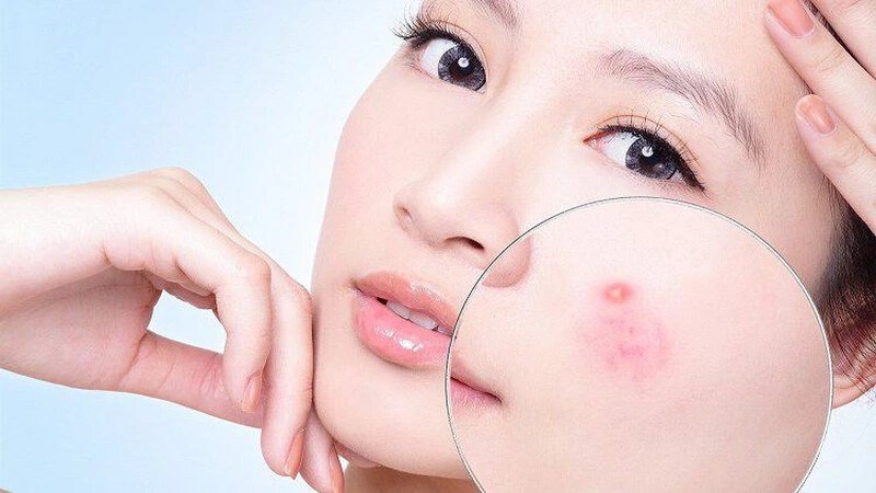 Một công dụng khác nữa đó là ngăn ngừa mụn, đặc biệt là mụn trứng cá