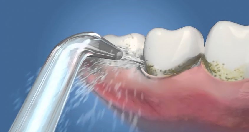 Tia nước của máy tăm nước có thể cải thiện nướu